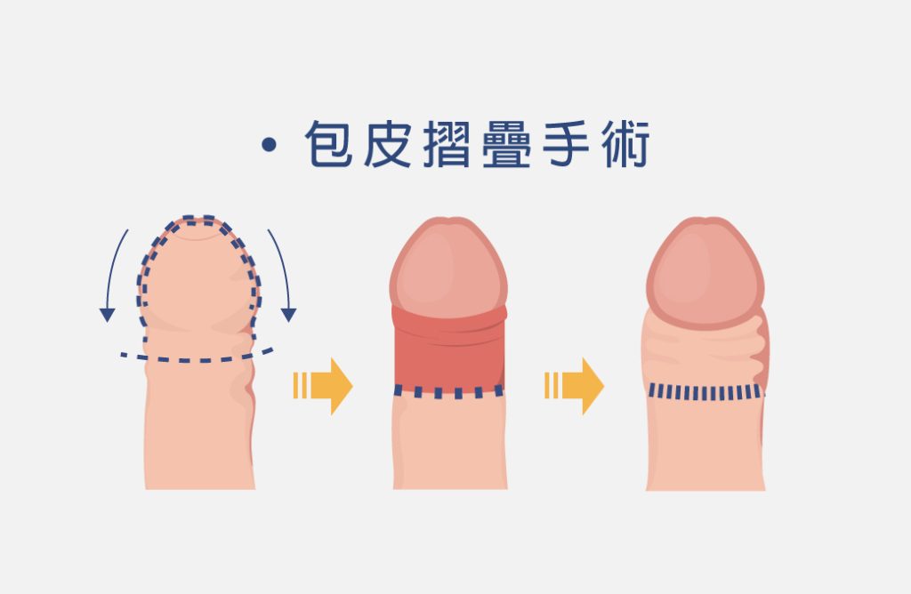 弟弟變大變粗不是夢！陰莖增大增粗、龜頭增大手術是什麼？