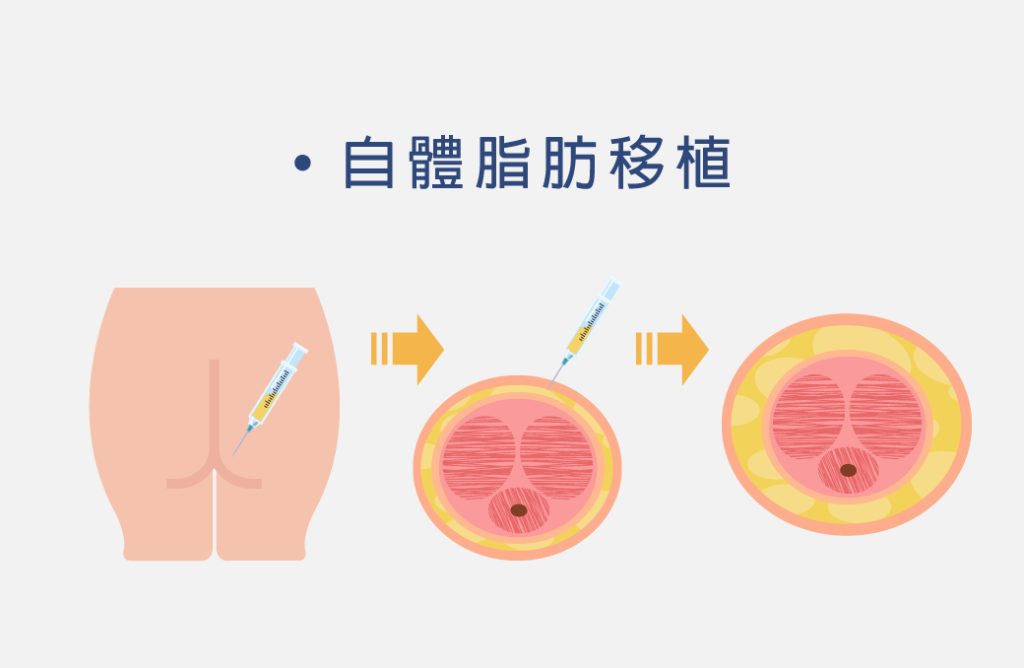 弟弟變大變粗不是夢！陰莖增大增粗、龜頭增大手術是什麼？