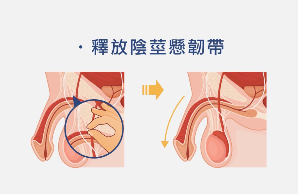 弟弟變大變粗不是夢！陰莖增大增粗、龜頭增大手術是什麼？