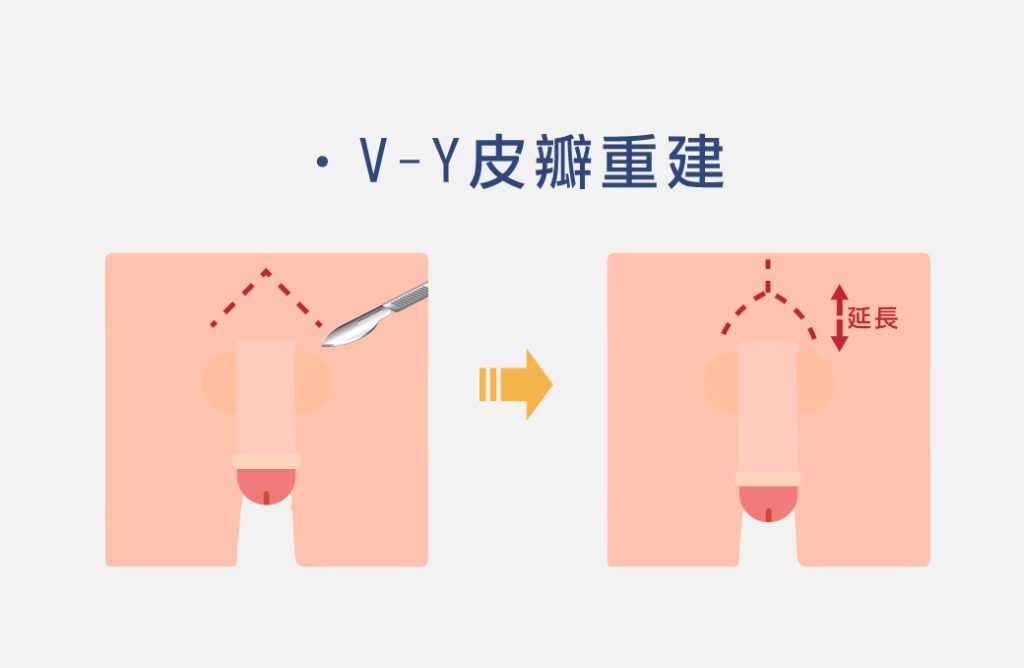 弟弟變大變粗不是夢！陰莖增大增粗、龜頭增大手術是什麼？